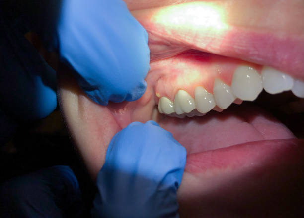 Best Emergency Dental Services for Seniors in Bradford Woods, PA